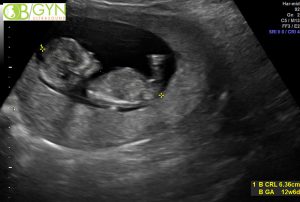 Ultrasound image