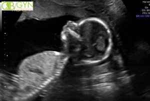 Ultrasound image