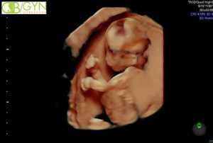 Ultrasound image