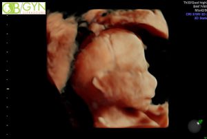 Ultrasound image