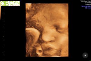 Ultrasound image