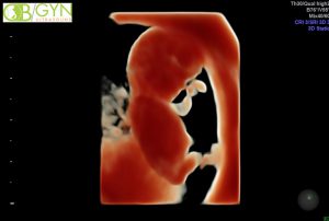 Ultrasound image